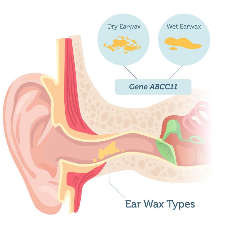 Earwax Type DNA Test – DNA Access Lab
