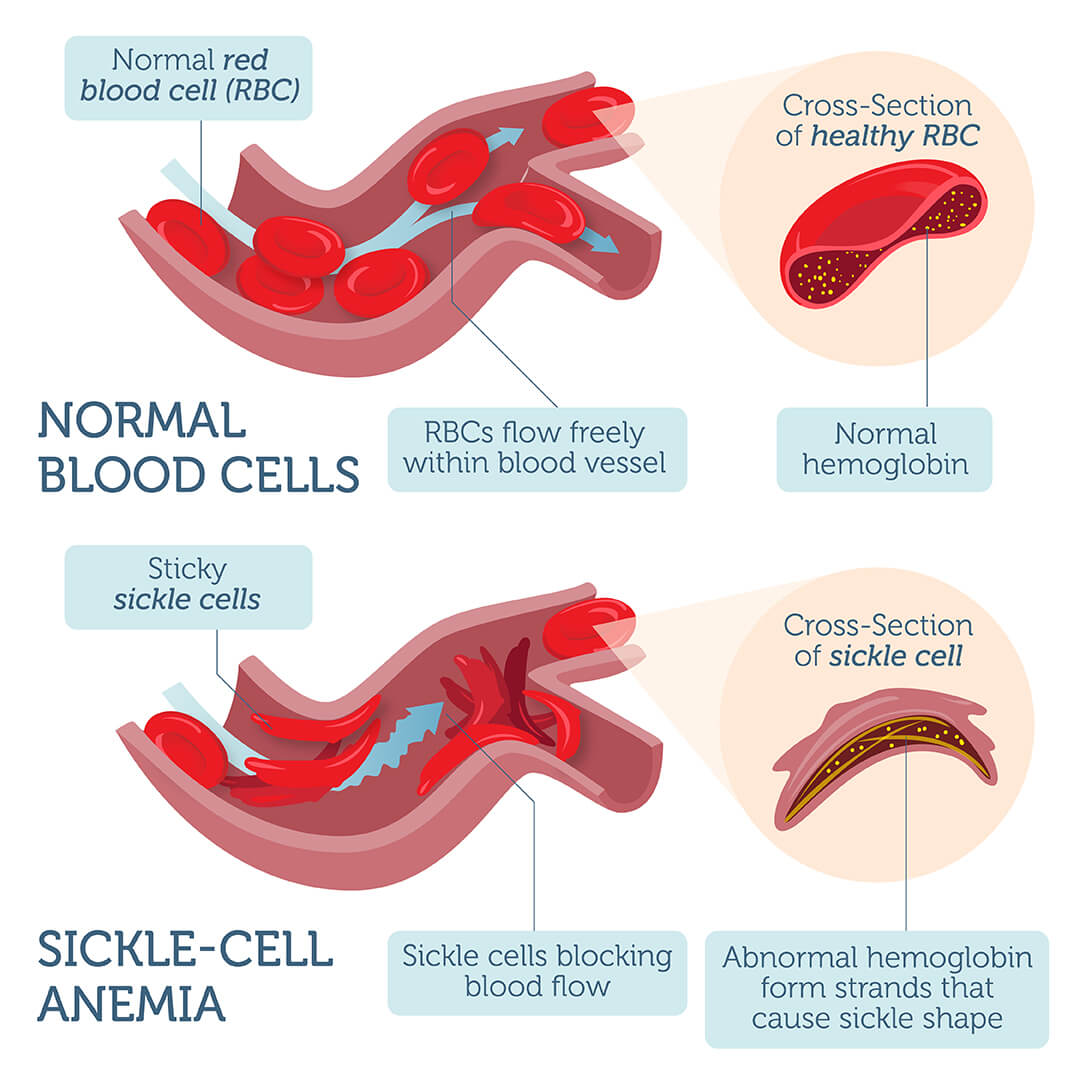current research on sickle cell anemia 2019